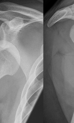 Dislocation 2 Dislocated shoulder X ray 031 150x250 1